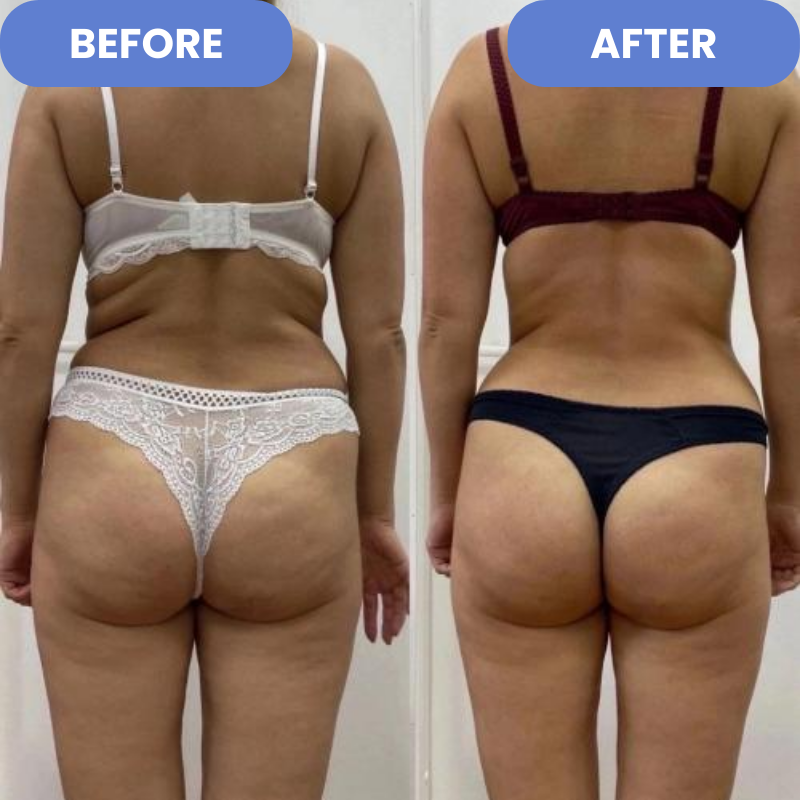 Anti Cellulite & Stretch Marks Massager
