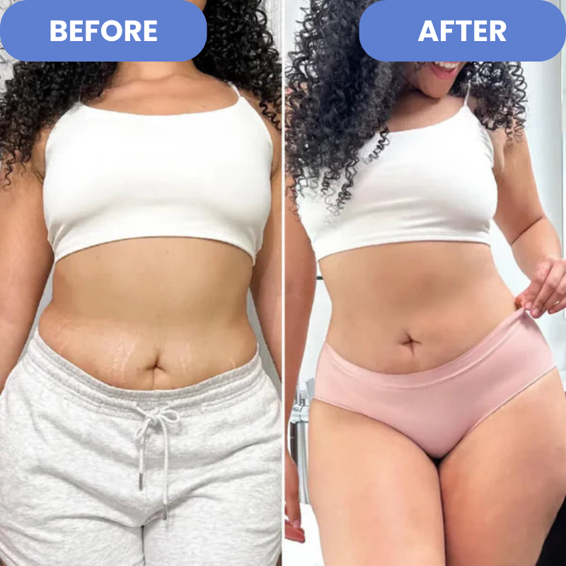 Anti Cellulite & Stretch Marks Massager